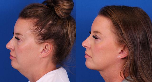 Rhinoplasty result at Omaha Face & Body in Elkhorn, NE