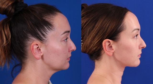 Neck Lift result at Omaha Face & Body in Elkhorn, NE