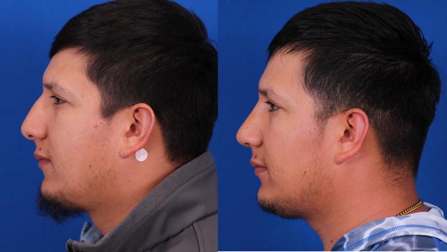 Rhinoplasty result at Omaha Face & Body in Elkhorn, NE