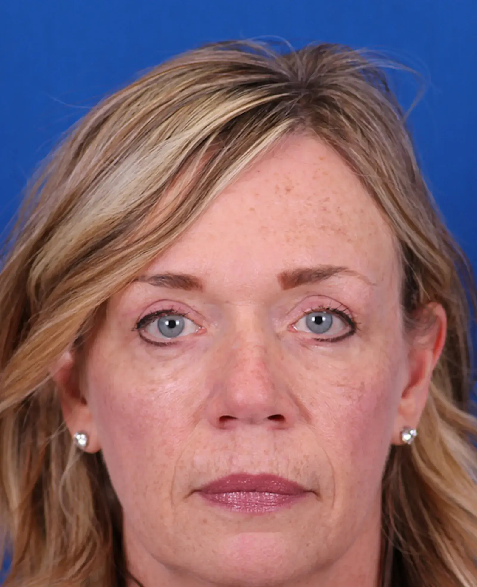 Omaha Face & Body eyelid lift after — Elkhorn, NE
