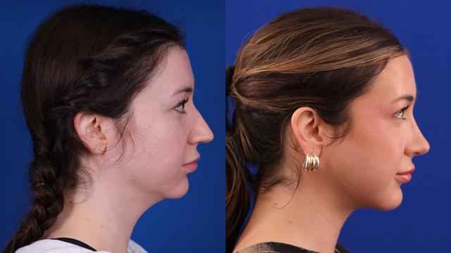 Rhinoplasty result at Omaha Face & Body in Elkhorn, NE