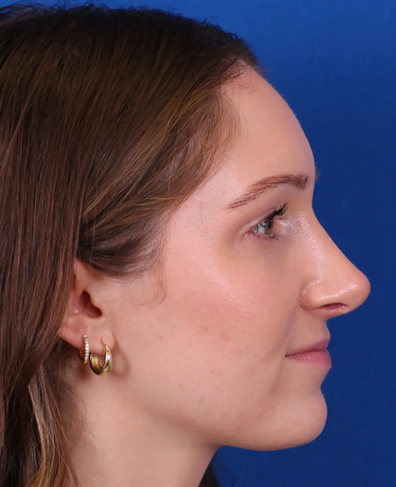 Omaha Face & Body rhinoplasty after — Elkhorn, NE