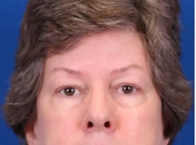 Blepharoplasty before at Omaha Face & Body in Elkhorn, NE