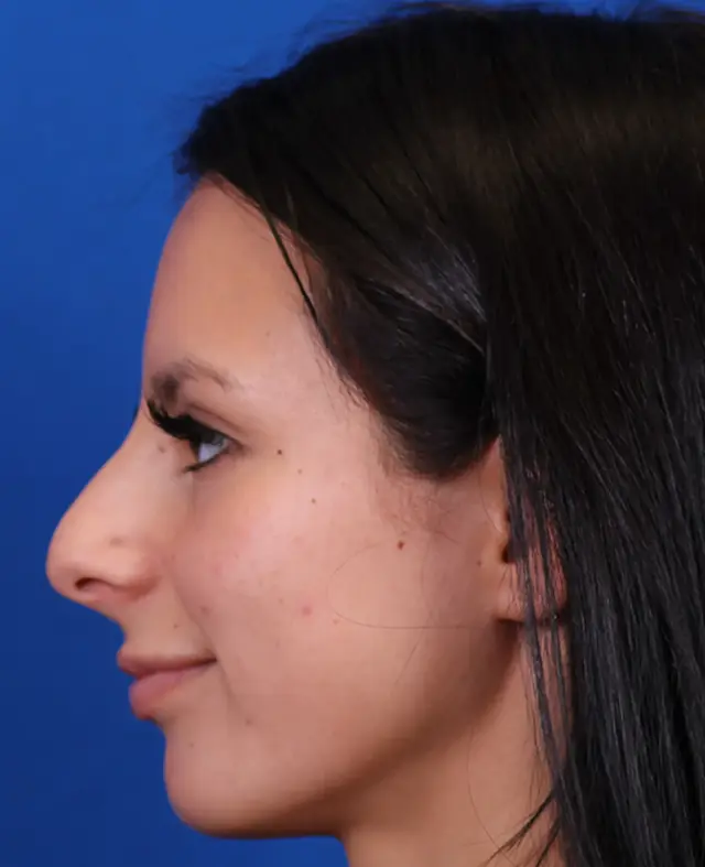 Functional Rhinoplasty before at Omaha Face & Body in Elkhorn, NE