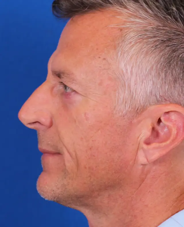 Functional Rhinoplasty before at Omaha Face & Body in Elkhorn, NE