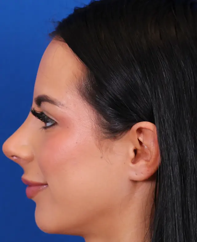 Functional Rhinoplasty after at Omaha Face & Body in Elkhorn, NE
