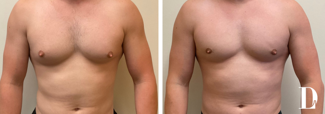 Dr. Liland - Park Cities Plastic Surgery gynecomastia result — Dallas, TX