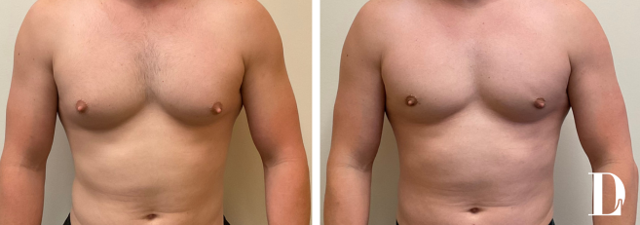 Gynecomastia Surgery result at Dr. Liland - Park Cities Plastic Surgery in Dallas, TX