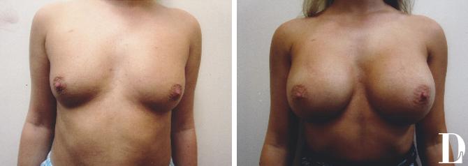 Dr. Liland - Park Cities Plastic Surgery result — Dallas, TX