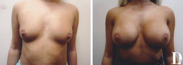 Fat Transfer Breast Augmentation result at Dr. Liland - Park Cities Plastic Surgery in Dallas, TX