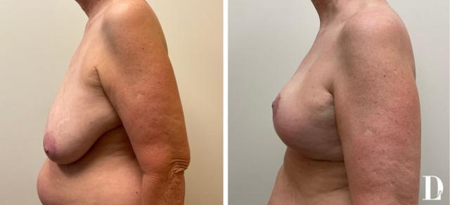 Breast Reduction result at Dr. Liland - Park Cities Plastic Surgery in Dallas, TX