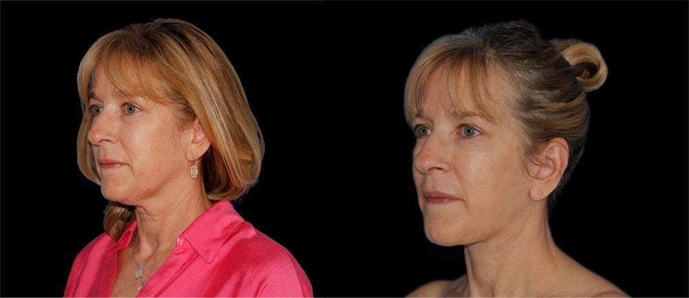 Ikon Plastic Surgery (James M. Economides, MD) facelift result — Chevy Chase, MD