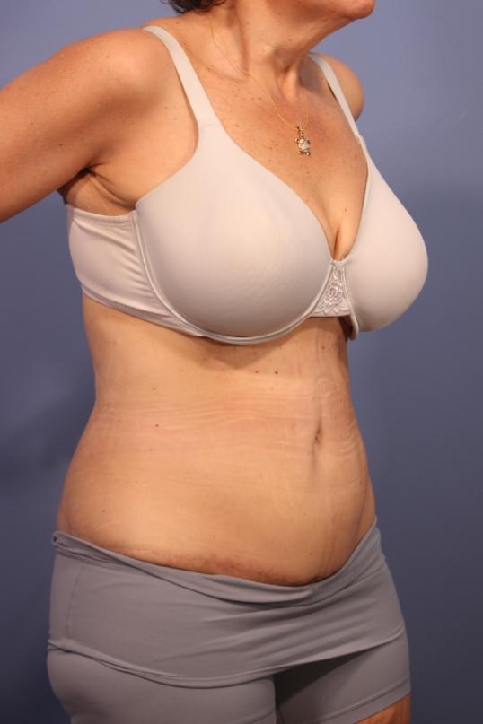 Tummy Tuck after at Dauwe Plastic Surgery in Dallas, TX