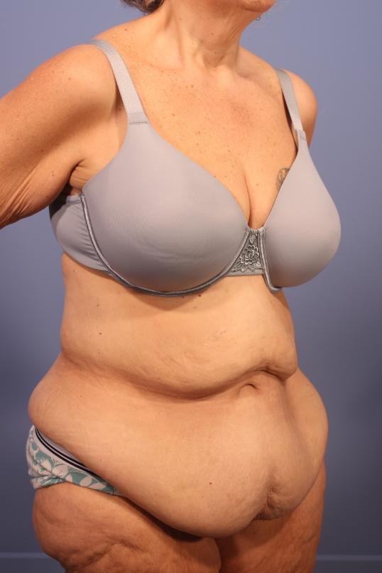 Tummy Tuck before at Dauwe Plastic Surgery in Dallas, TX