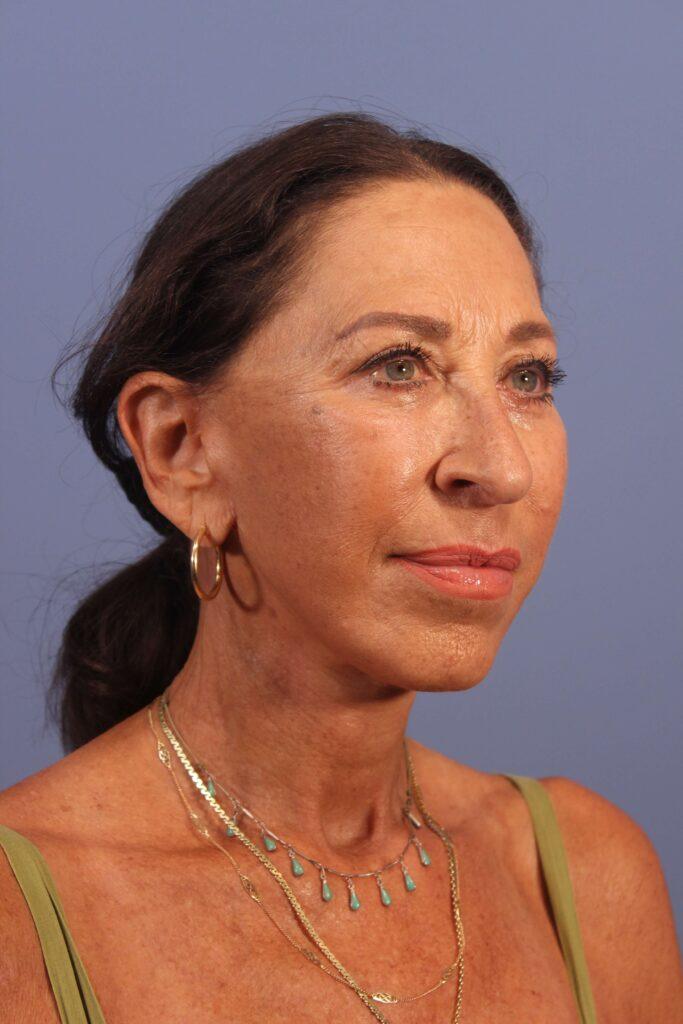 Dauwe Plastic Surgery facelift after — Dallas, TX