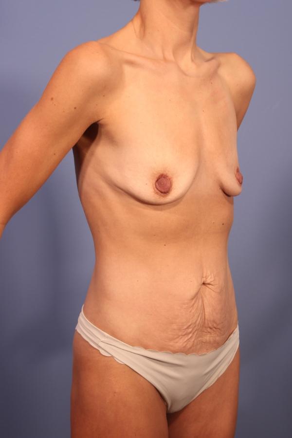 Mommy Makeover before at Dauwe Plastic Surgery in Dallas, TX