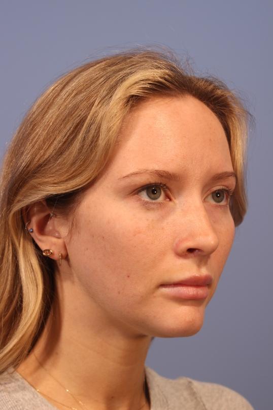 Chin Implant after at Dauwe Plastic Surgery in Dallas, TX