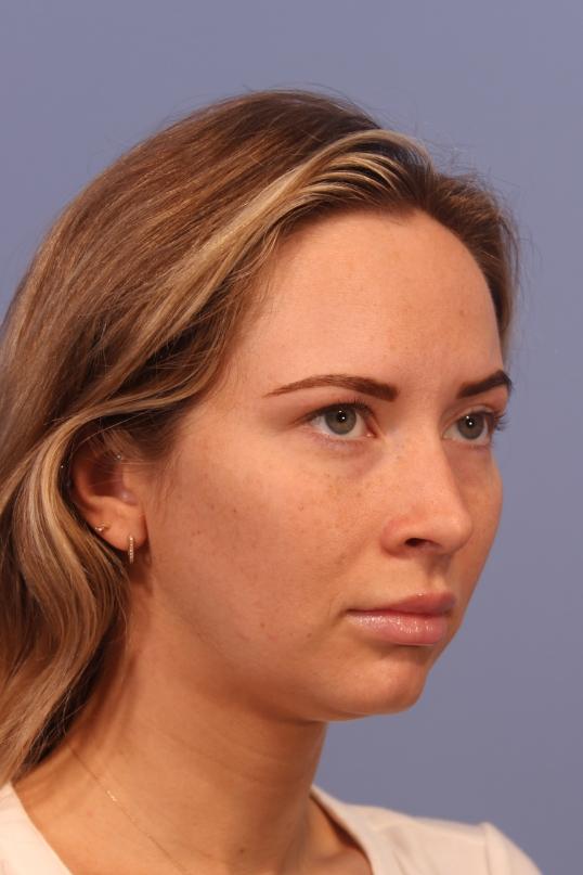 Chin Implant before at Dauwe Plastic Surgery in Dallas, TX