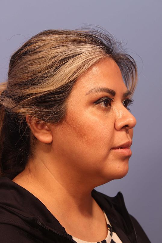 Neck Liposuction before at Dauwe Plastic Surgery in Dallas, TX