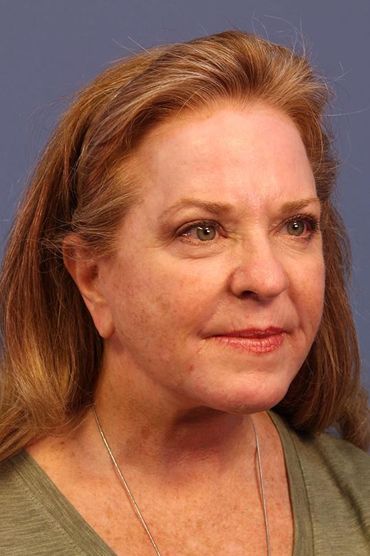 Dauwe Plastic Surgery facelift after — Dallas, TX