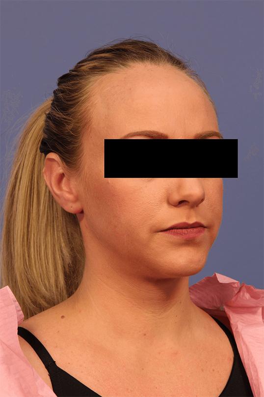 Chin Implant after at Dauwe Plastic Surgery in Dallas, TX