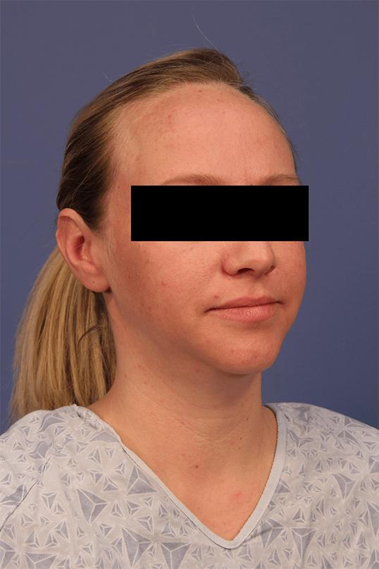 Chin Implant before at Dauwe Plastic Surgery in Dallas, TX