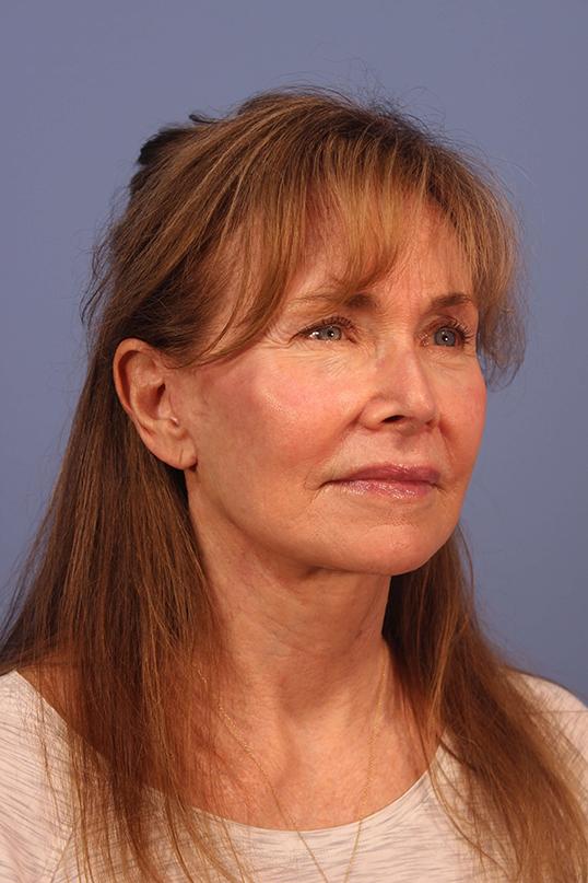 Dauwe Plastic Surgery facelift after — Dallas, TX