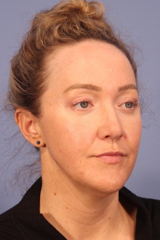 Blepharoplasty after at Dauwe Plastic Surgery in Dallas, TX