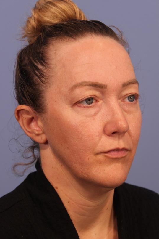 Blepharoplasty before at Dauwe Plastic Surgery in Dallas, TX