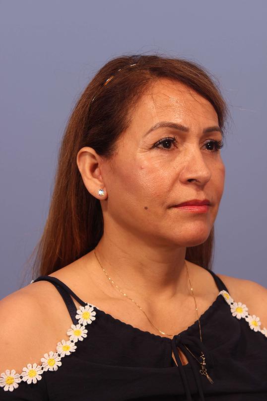 Dauwe Plastic Surgery facelift after — Dallas, TX