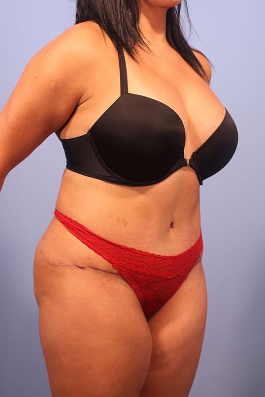 Dauwe Plastic Surgery tummy tuck after — Dallas, TX