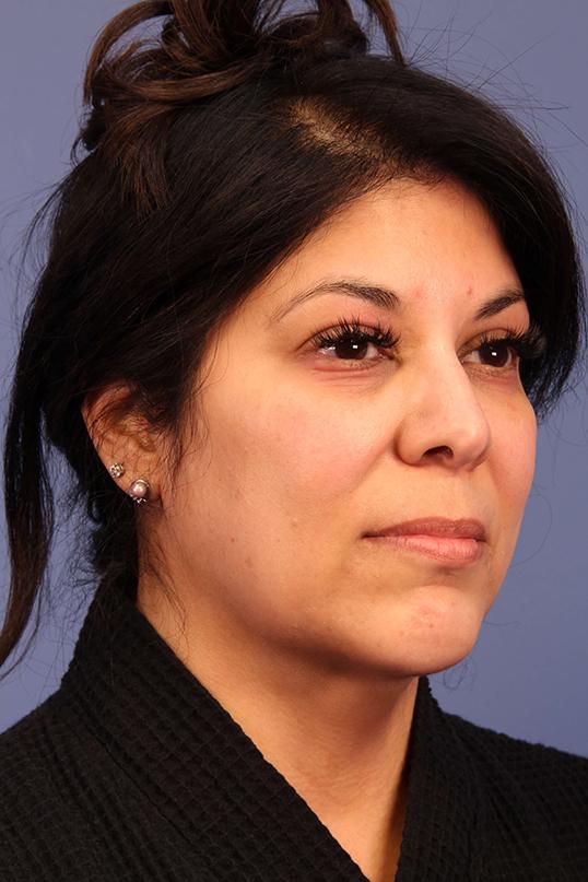 Chin Implant after at Dauwe Plastic Surgery in Dallas, TX