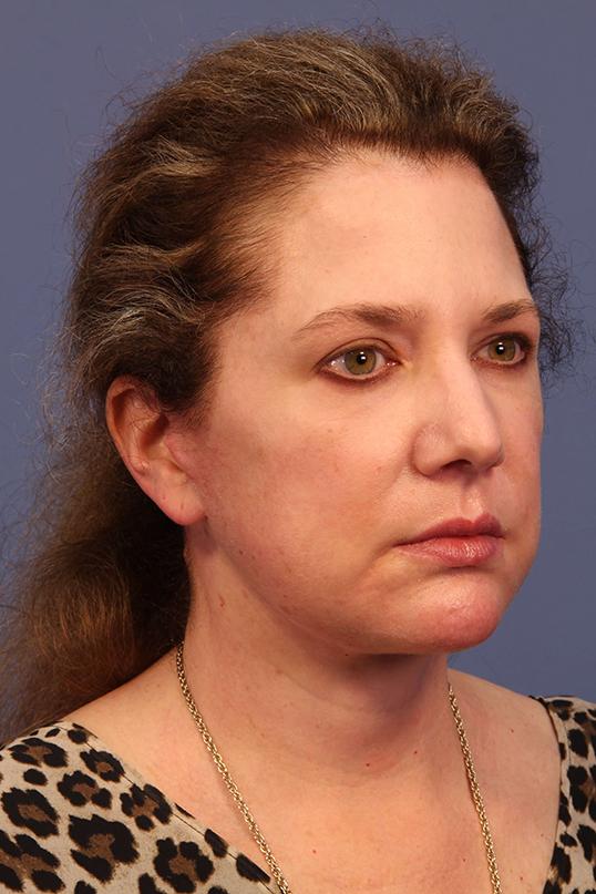 Neck Lift after at Dauwe Plastic Surgery in Dallas, TX