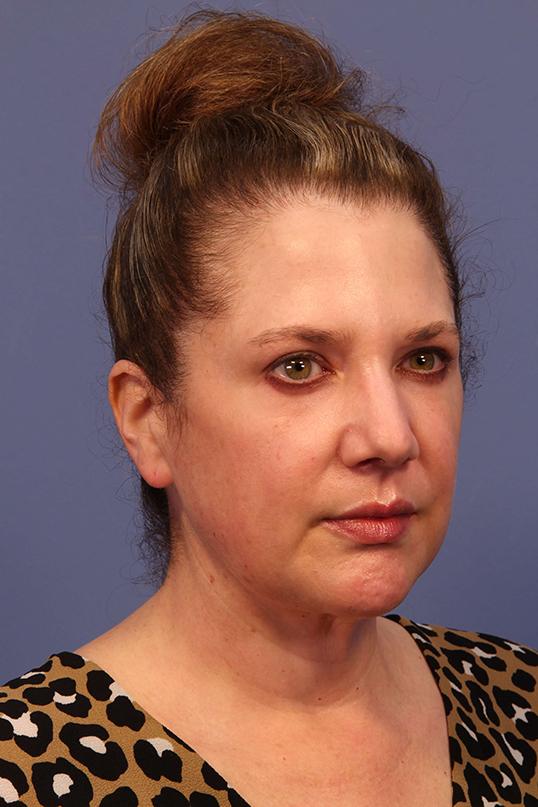 Neck Lift before at Dauwe Plastic Surgery in Dallas, TX