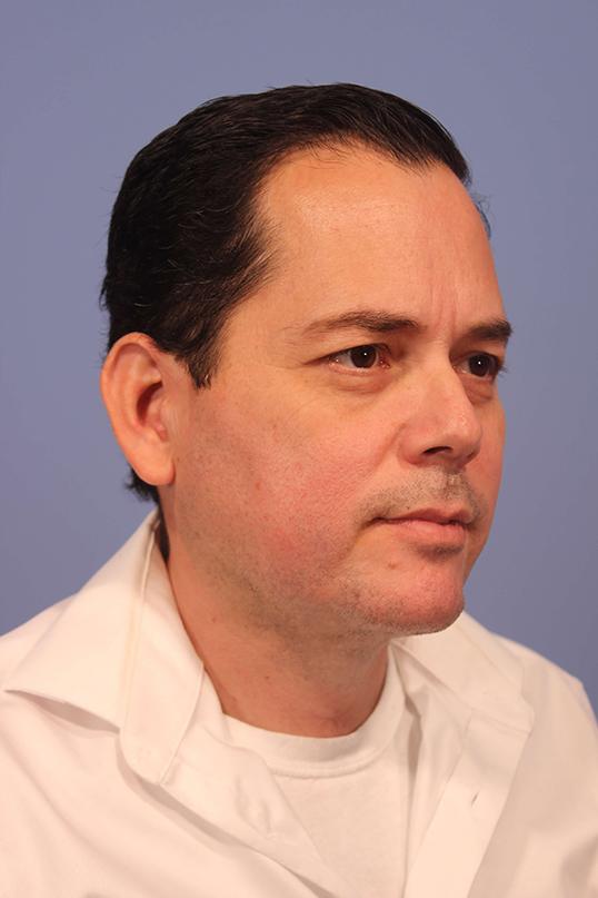 Chin Implant after at Dauwe Plastic Surgery in Dallas, TX