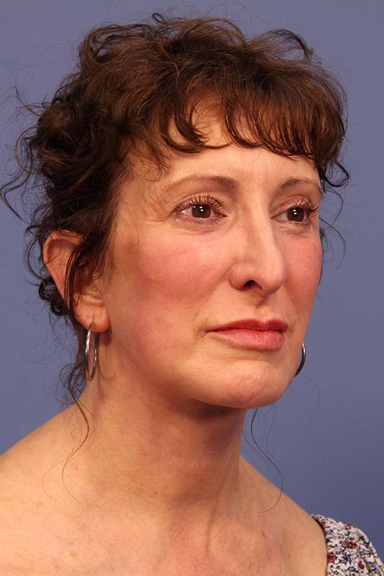 Dauwe Plastic Surgery facelift after — Dallas, TX