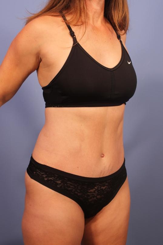 Tummy Tuck after at Dauwe Plastic Surgery in Dallas, TX