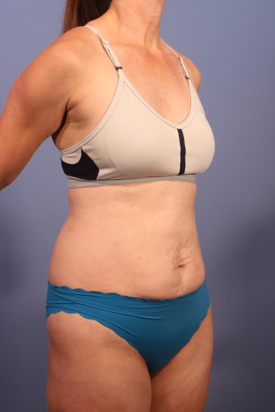 Tummy Tuck before at Dauwe Plastic Surgery in Dallas, TX