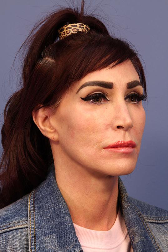 Dauwe Plastic Surgery facelift after — Dallas, TX