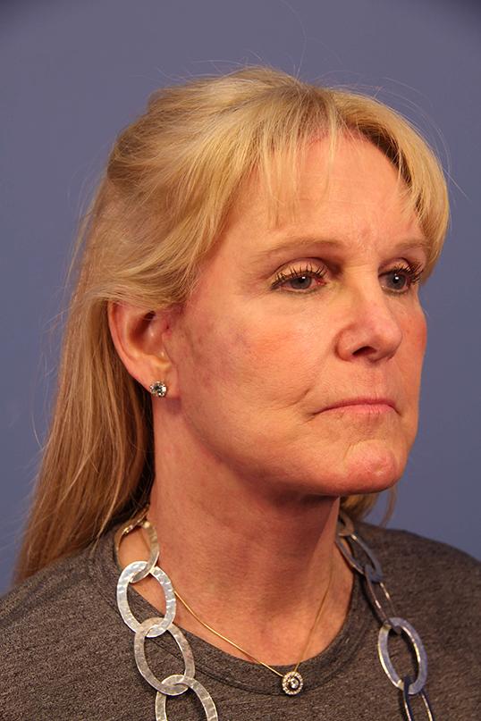 Dauwe Plastic Surgery facelift after — Dallas, TX
