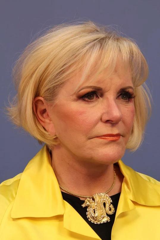 Dauwe Plastic Surgery facelift after — Dallas, TX