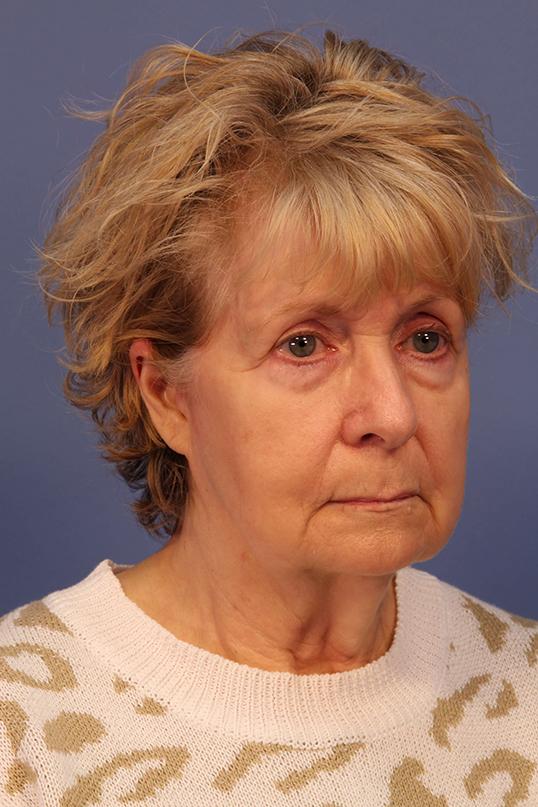 Brow Lift before at Dauwe Plastic Surgery in Dallas, TX
