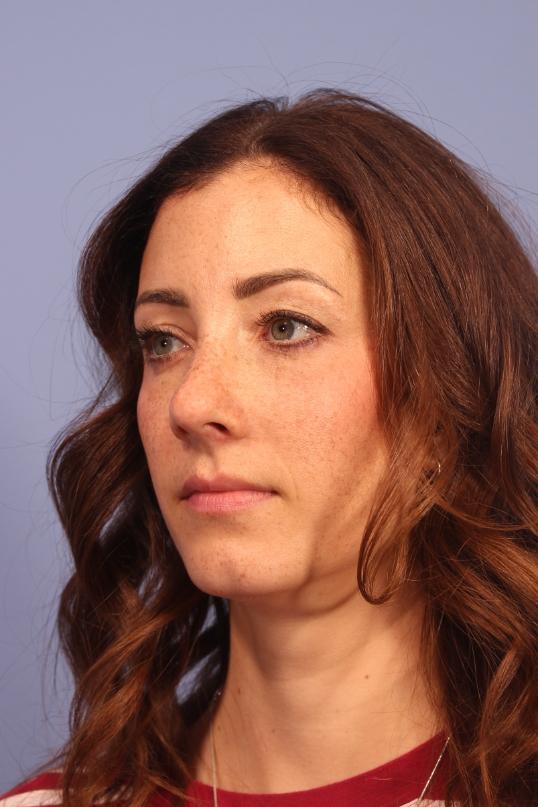 Dauwe Plastic Surgery blepharoplasty after — Dallas, TX