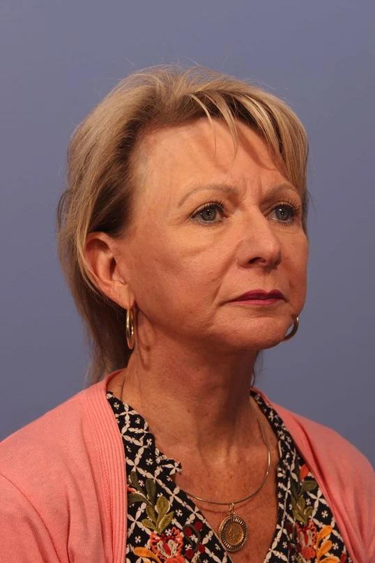 Dauwe Plastic Surgery facelift after — Dallas, TX