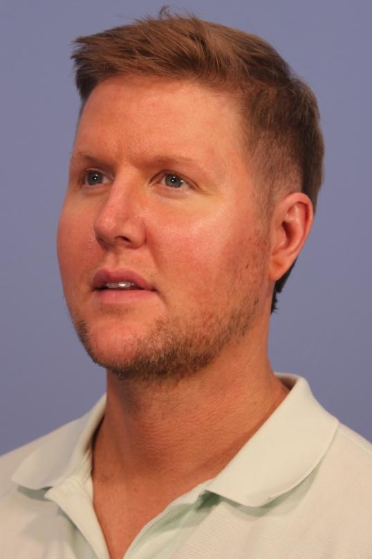 Chin Implant after at Dauwe Plastic Surgery in Dallas, TX