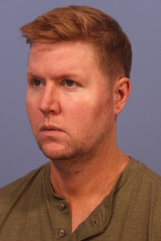 Chin Implant before at Dauwe Plastic Surgery in Dallas, TX