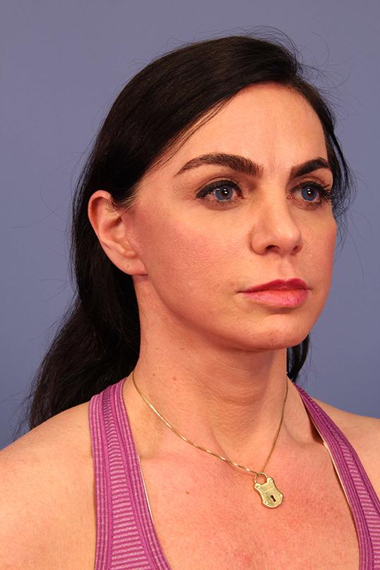 Brow Lift after at Dauwe Plastic Surgery in Dallas, TX