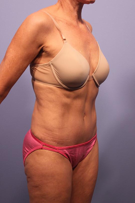 Dauwe Plastic Surgery tummy tuck after — Dallas, TX