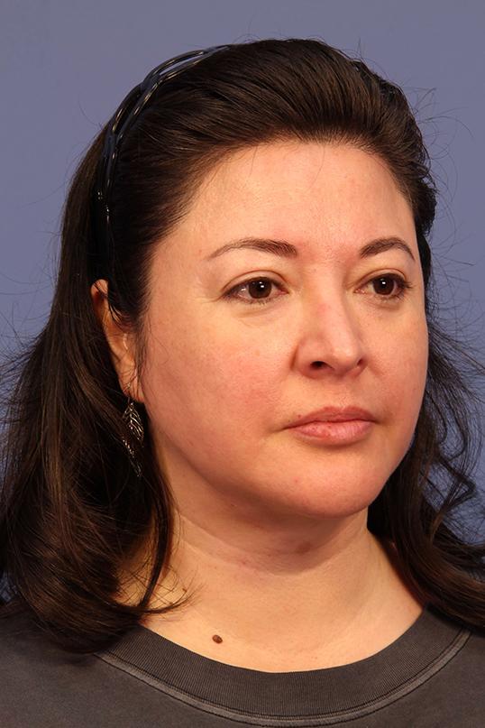 Chin Implant after at Dauwe Plastic Surgery in Dallas, TX