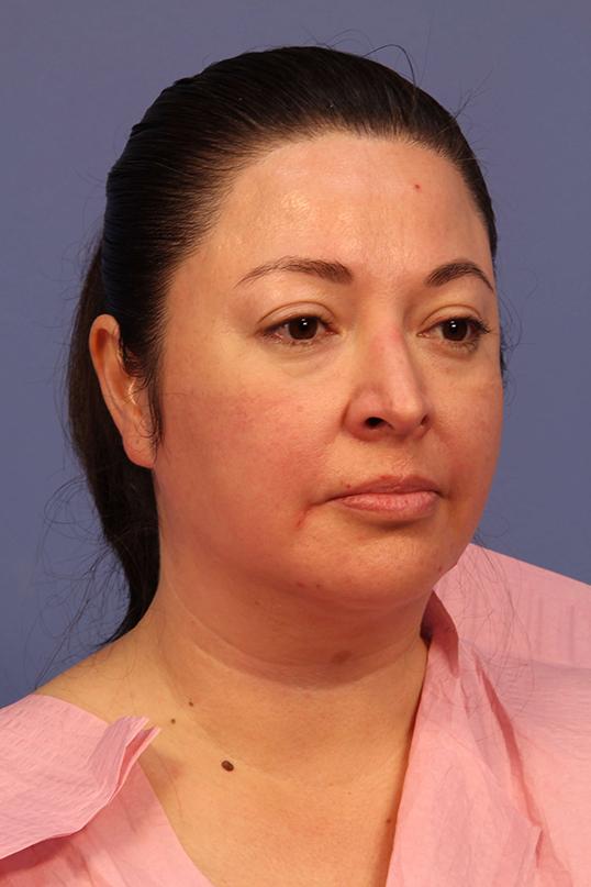 Chin Implant before at Dauwe Plastic Surgery in Dallas, TX